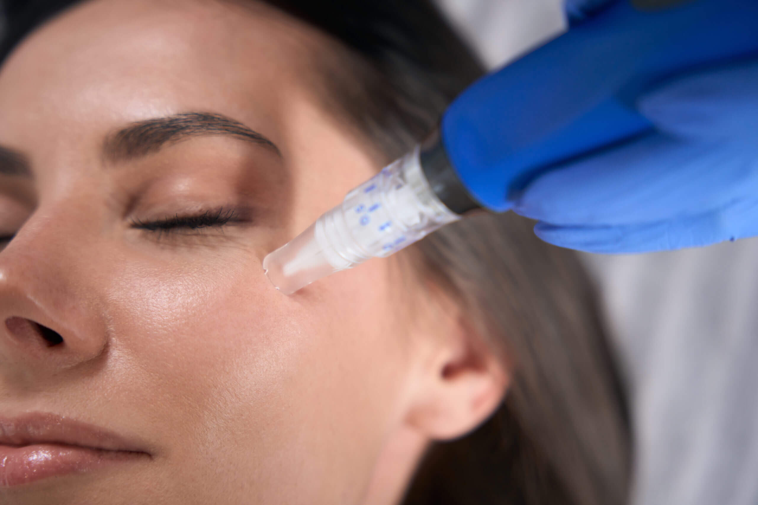 Microneedling by Skin Ritual in East Boston Street Gilbert Arizona