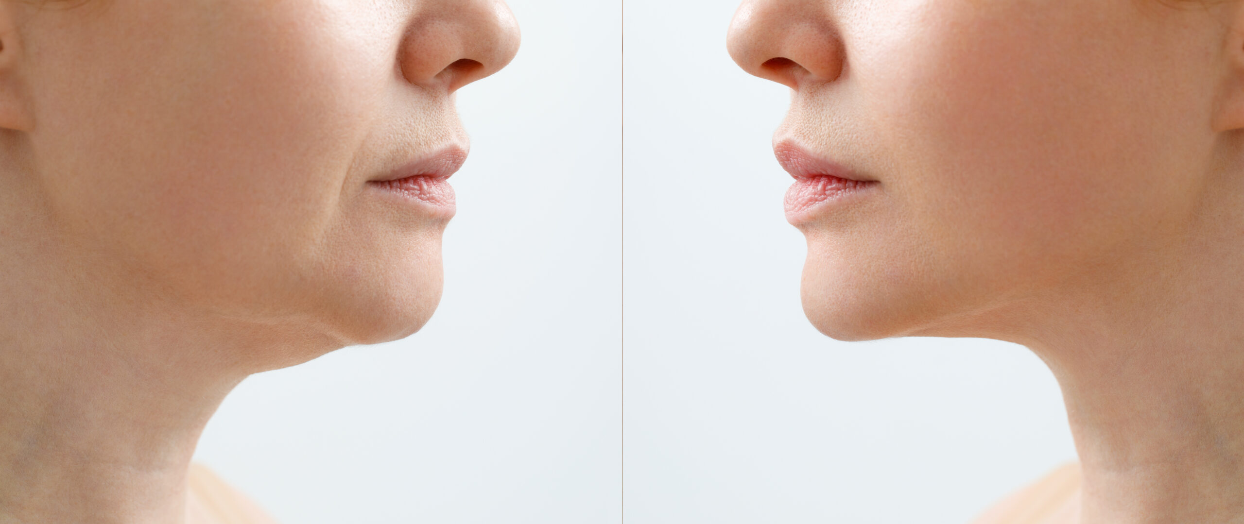 How Long Does Kybella Last? Skin Ritual | Gilbert, Arizona