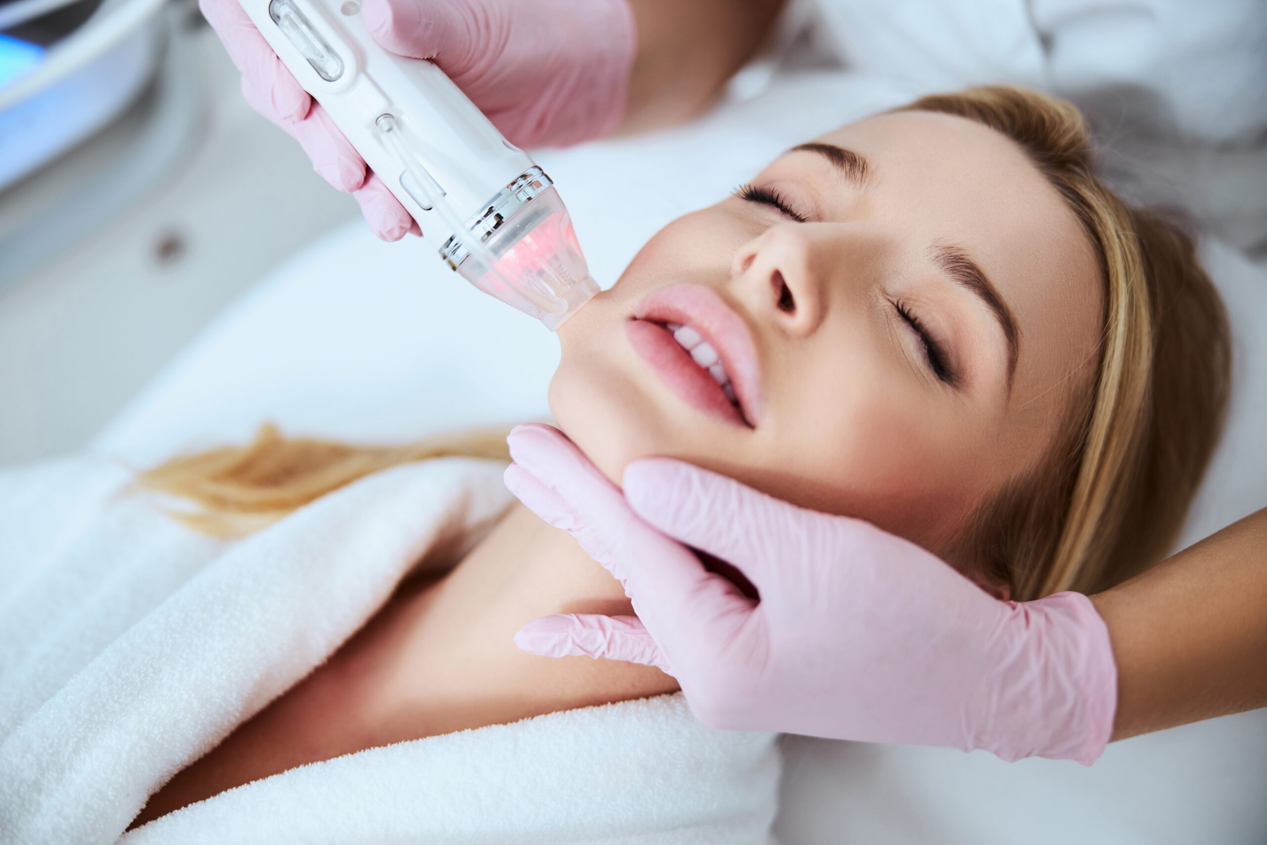 Vivace RF Microneedling in Gilbert, Arizona at Skin Ritual