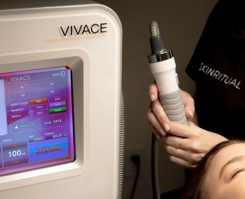 Vivace RF Microneedling in Gilbert, AZ